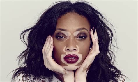 Winnie-Harlow-Vitiligo - Windows Mode