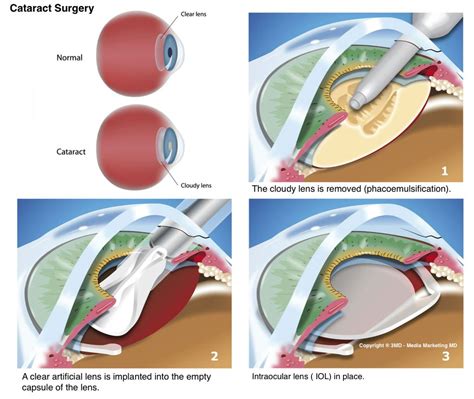 Cataract Surgery Procedure: Safety, Recovery, and Effects