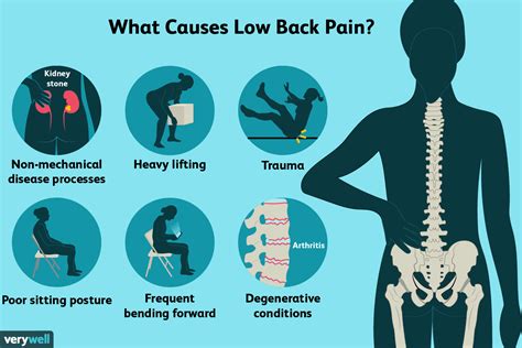 Symptoms Of Sciatica Buttock