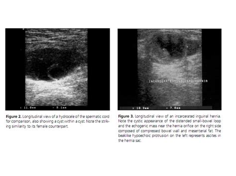 BÀI SOẠN VỀ SIÊU ÂM CHẨN ĐOÁN: FEMALE HYDROCELE [CYST of the CANAL of NUCK]