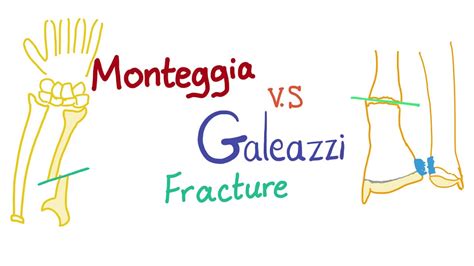 Galeazzi Fracture Classification