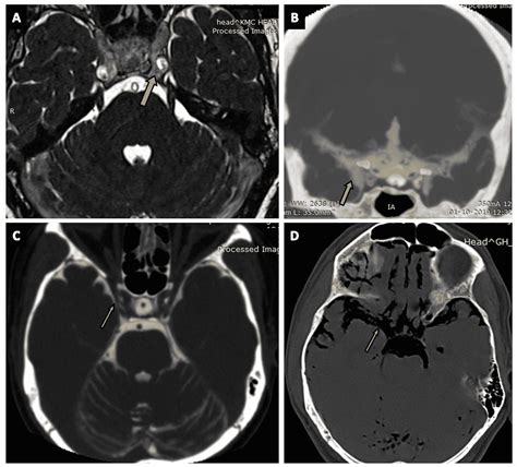 Cureus | Delineation of Subarachnoid Cisterns Using CT Cisternography, CT Brain Positive and ...