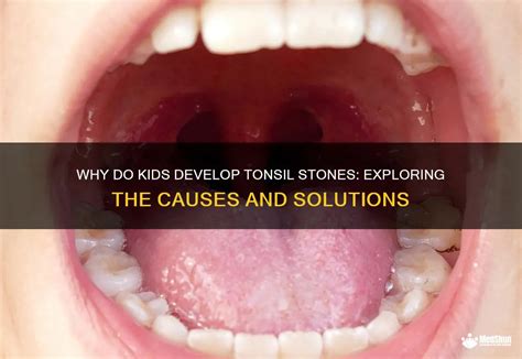 Why Do Kids Develop Tonsil Stones: Exploring The Causes And Solutions | MedShun