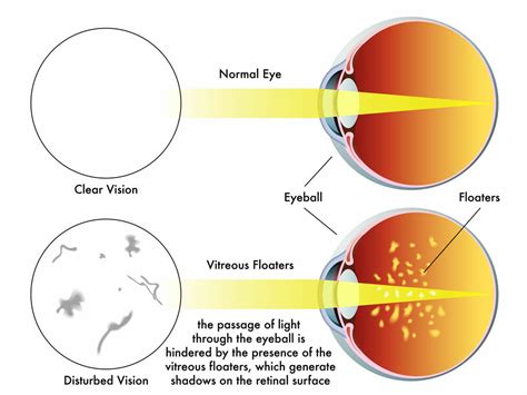 Floater in eye after cataract surgery | doctorvisit