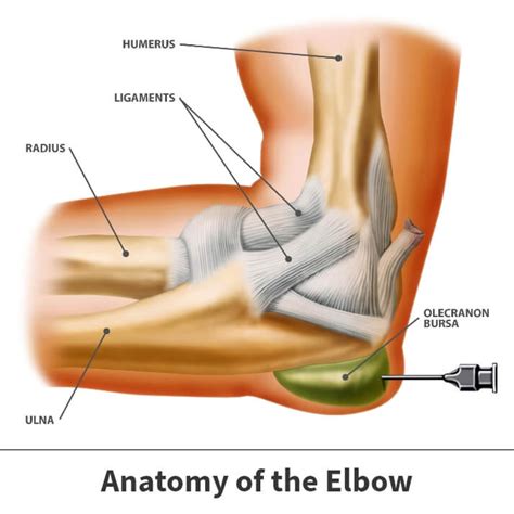 Bursitis of the Elbow | Florida Orthopaedic Institute