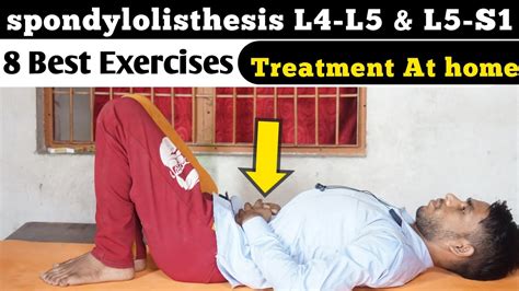 spondylolisthesis l5 s1 exercises, spondylolisthesis l5 s1 grade 1, anterolisthesis l4 L5 ...