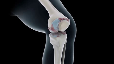 Biomedical Animation Of Knee Replacement Stock Motion Graphics SBV ...