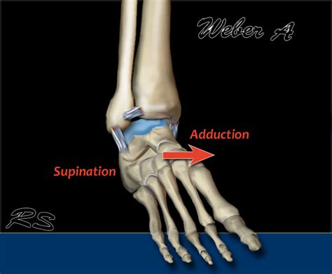 The Radiology Assistant : Ankle fracture - Weber and Lauge-Hansen Classification