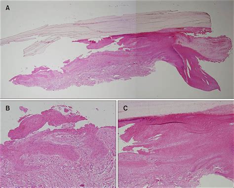 Onychopapilloma Presenting as Erythronychia and Leukonychia ...