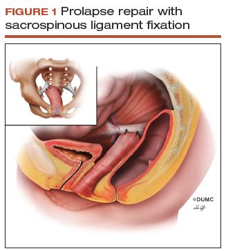 Optimal surgical management of stage 3 and 4 pelvic organ prolapse | MDedge ObGyn