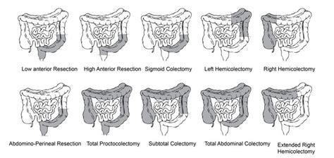 Colon Resection