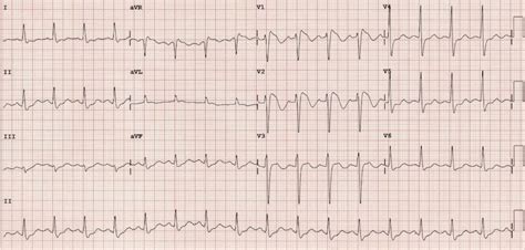 Right Bundle Branch Block (RBBB) • LITFL • ECG Library Diagnosis