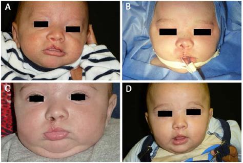 RBCP - Exclusive use of absorbable suture threads in cleft lip and palate