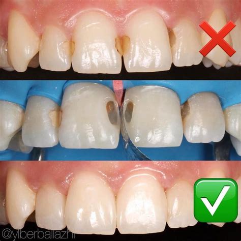 how do composite fillings work - Ilana Ponce