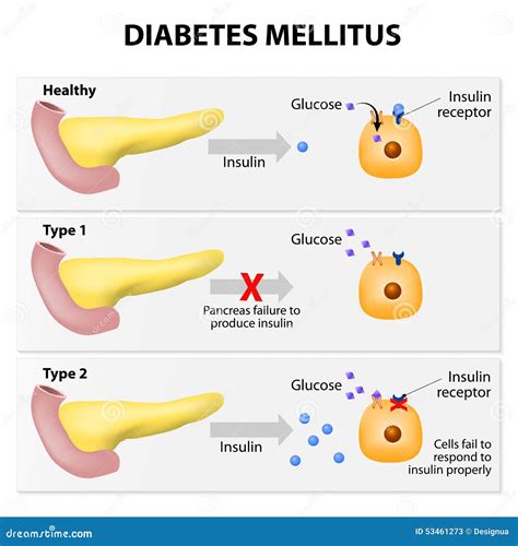 Diabetes mellitus stock vector. Illustration of healthy - 53461273