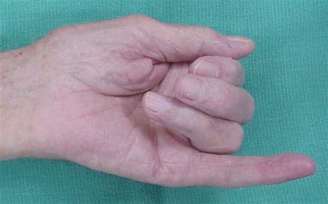 Reconstruction: Small finger flexor tendon rupture within the carpal tunnel