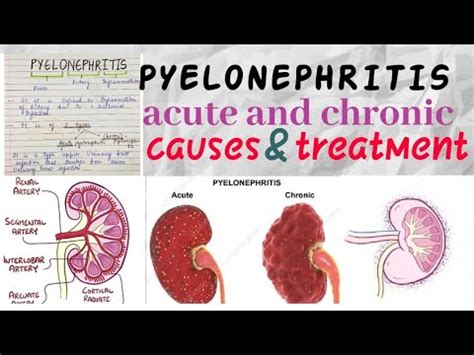 ACUTE AND CHRONIC PYELONEPHRITIS (with cause, symptoms and treatment ...