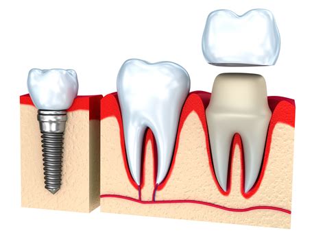 Caps & Crowns –Tooth Cap Or Gold Cap? Get Expert Advice!