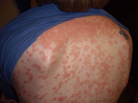 File:Guttate psoriasis.jpg - Wikipedia