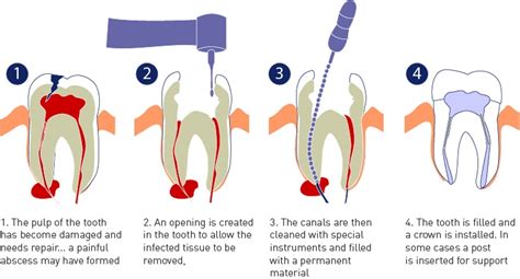 Root Canal Treatment : Need, Complications and Instructions