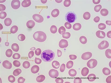 Megaloblastic Anemia - 1 | ERA