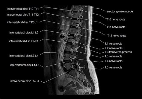 Mri spine anatomy free mri lumbar spine sagittal cross sectional anatomy – Artofit