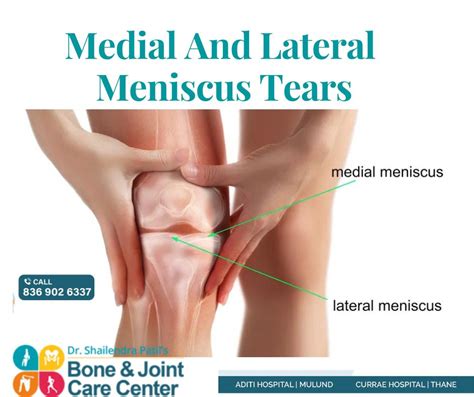 Medial Meniscus Tear