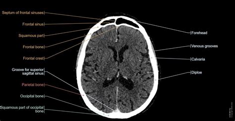 Normal Brain Ct Scan Labeled