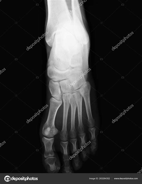 Foot Xray Top View – Stock Editorial Photo © YAYImages #263264352