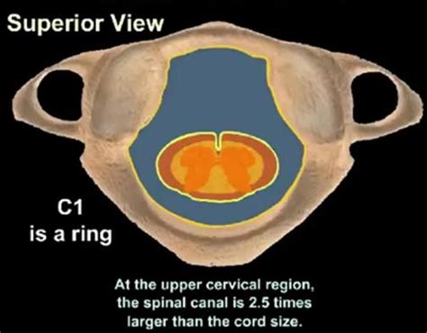 Atlantoaxial Instability - Spine - Orthobullets