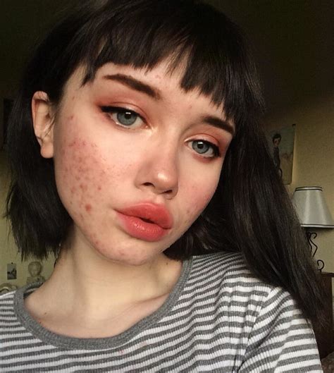 Garota com acne posta fotos sem maquiagem e inspira outras pessoas - Harper's Bazaar » Moda ...