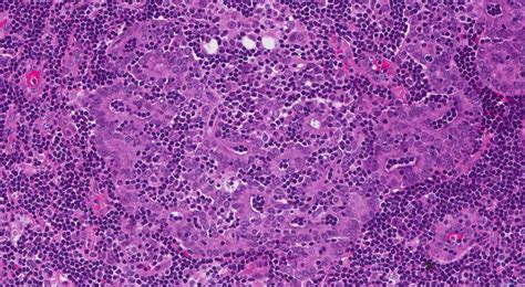 Acinic cell carcinoma of the salivary glands | Ottawa Atlas of Pathology