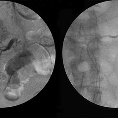 Renal angiogram: decreased flow bilaterally with abnormalities of the... | Download Scientific ...