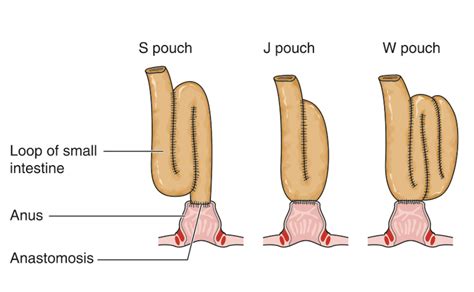 Restorative proctocolectomy with ileo-anal pouch