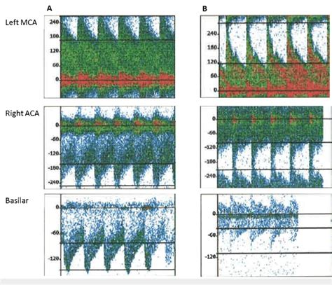 Transcranial Doppler (TCD) waveforms Transcranial Doppler (TCD ...