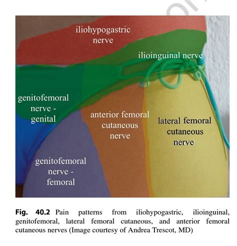 Ilioinguinal Neuralgia