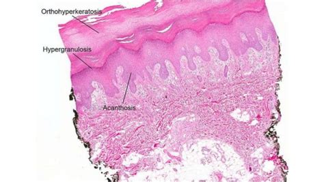 Palmoplantar Keratodermas