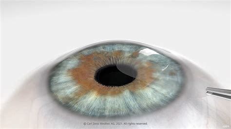 Implantable contact lenses vs lasik vs 2day lasek | Eye Surgery in Korea - GS Eye Clinic Blog