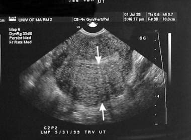 Adenomyosis | HusnaHuzepha