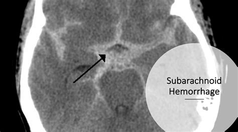 Ct Scan Of Subarachnoid Hemorrhage Dura Mater Subarac - vrogue.co