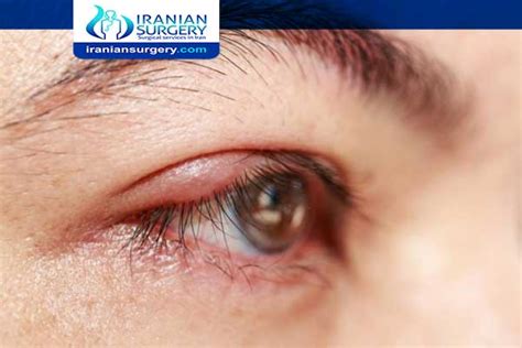 Chalazion surgery unsuccessful | chalazion surgery failure |Iranian Surgery