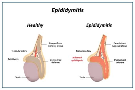 Epididymitis: Causes, Symptoms, Diagnosis, Treatment