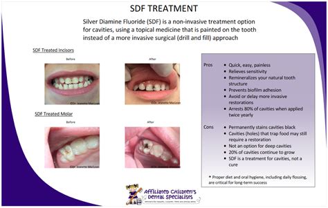 Paste To Fill Holes In Teeth - TeethWalls