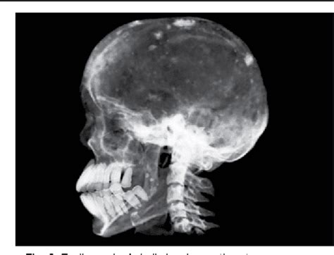 A Unique Case of O steitis Fibrosa Cystica with Postoperative Hungry Bone Syndrome and ...