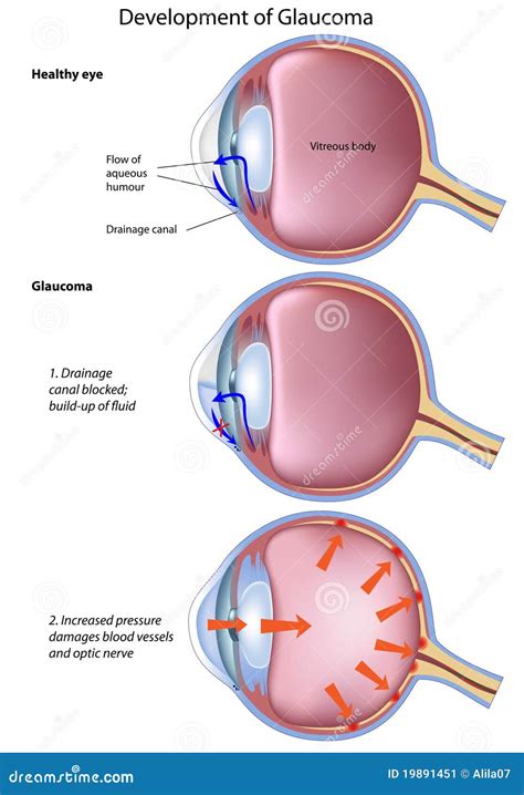 Stages of glaucoma stock vector. Illustration of blind - 19891451