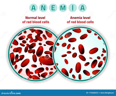 Anemia Level of Blood Cells Stock Vector - Illustration of compare, danger: 119268523