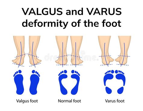 Valgus Deformities Stock Illustrations – 6 Valgus Deformities Stock Illustrations, Vectors ...