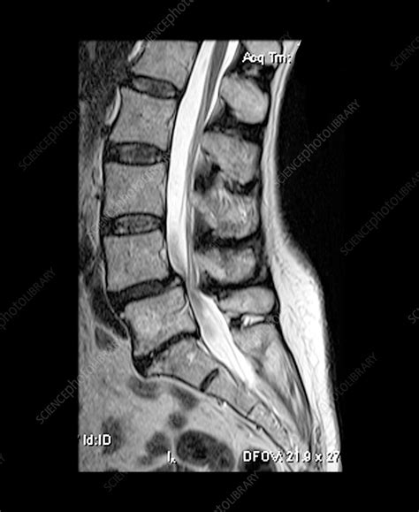 L4-5 Spondylolisthesis and Canal Steno - Stock Image - F031/9920 ...