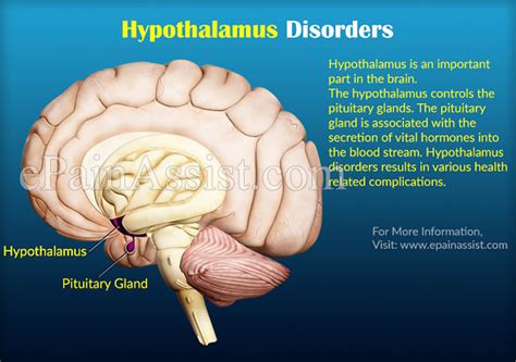 Hypothalamus Disorders|Causes|Symptoms|Treatment|Prognosis