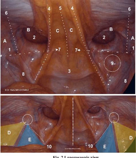 [PDF] LAPAROSCOPIC TRANSABDOMINAL PRE-PERITONEAL ( TAPP ) FOR BILATERAL INGUINAL HERNIA ...